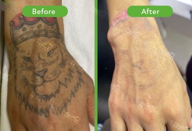 Tatoo Removal before after