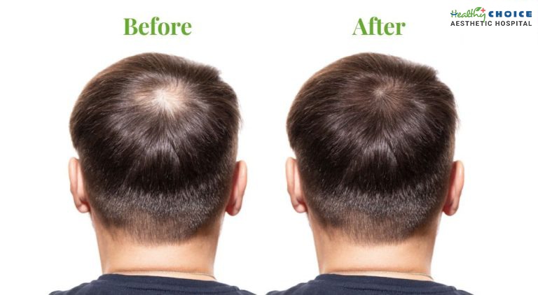 Gfc before after results
