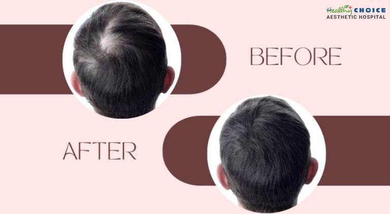 GFC before and after photos