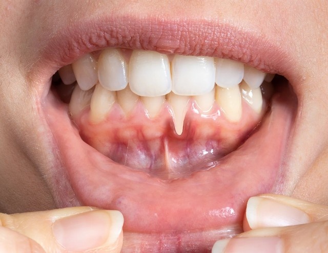 Gum Recession Treatment