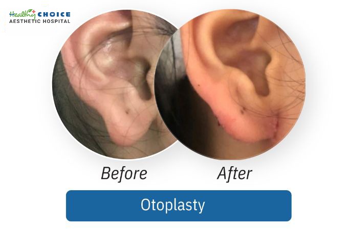 Otoplasty (Ear Reshaping/Pinning)