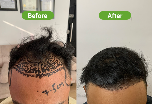 Hair transplant result