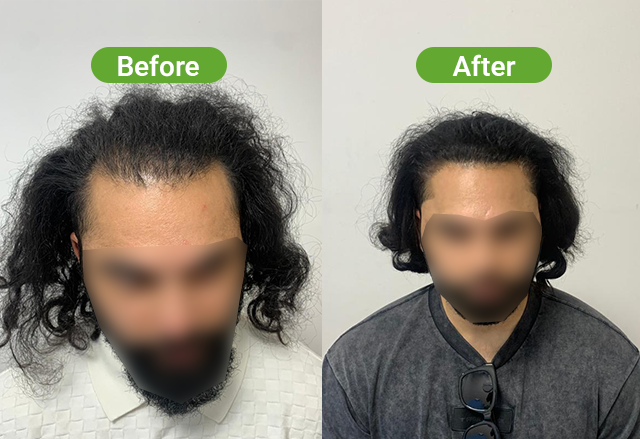 Hair transplant result