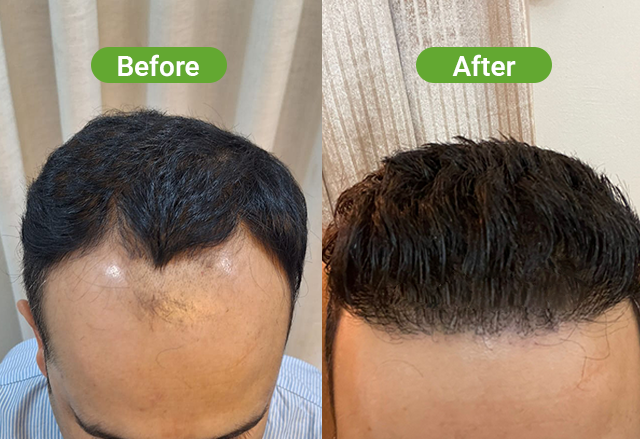 Hair transplant 7 month result