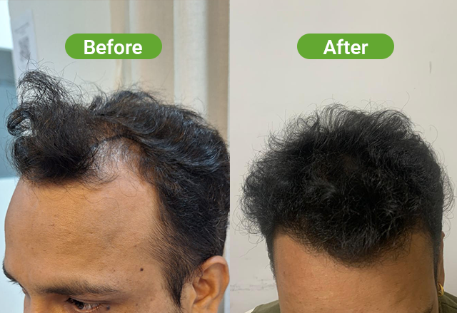 Hair transplant result