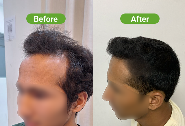 Hair transplant result