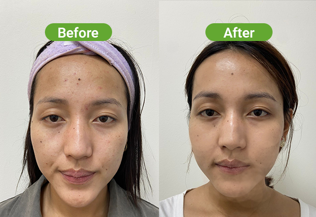 Chemical peel before after