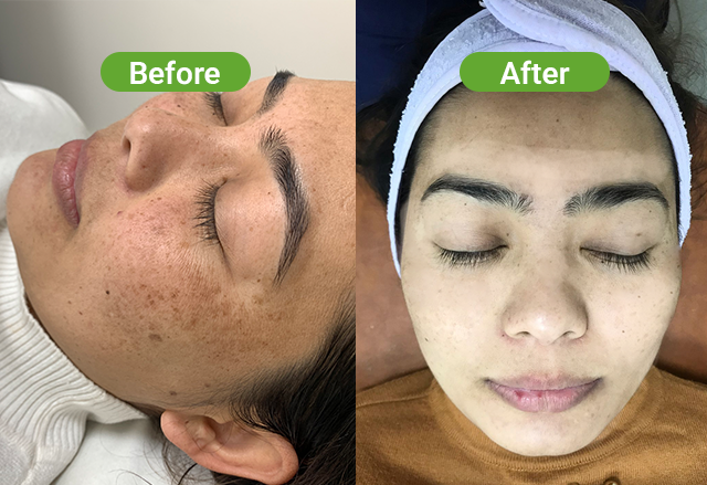 Chemical peel before after