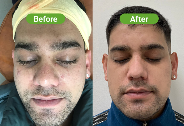 Chemical peel before after