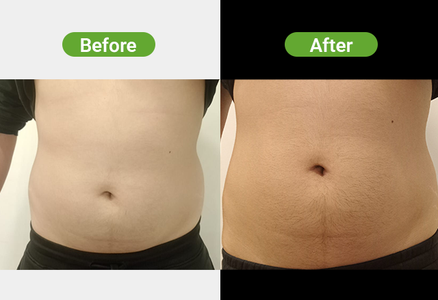 Cryolipolysis before and after