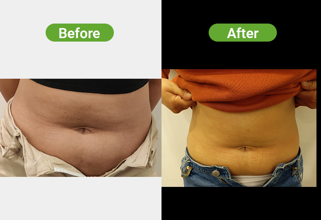 Cryolipolysis before and after