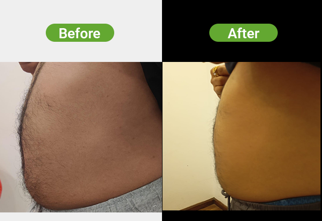 Cryolipolysis before and after