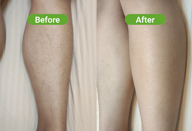Soprano laser hair removal