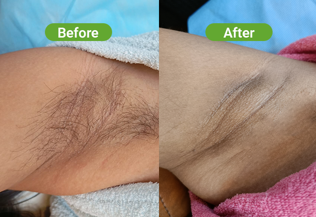 Soprano laser hair removal