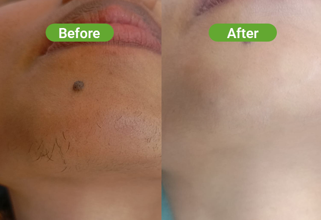 Soprano laser hair removal