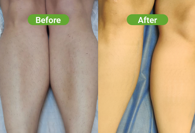 Soprano laser hair removal