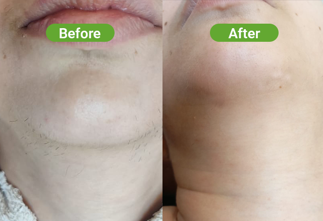 Soprano laser hair removal