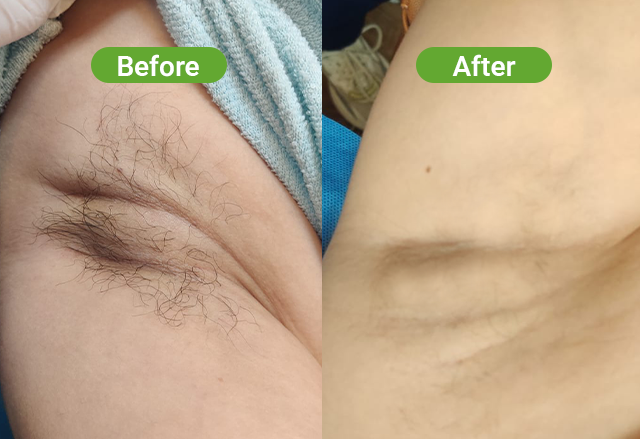 Soprano laser hair removal