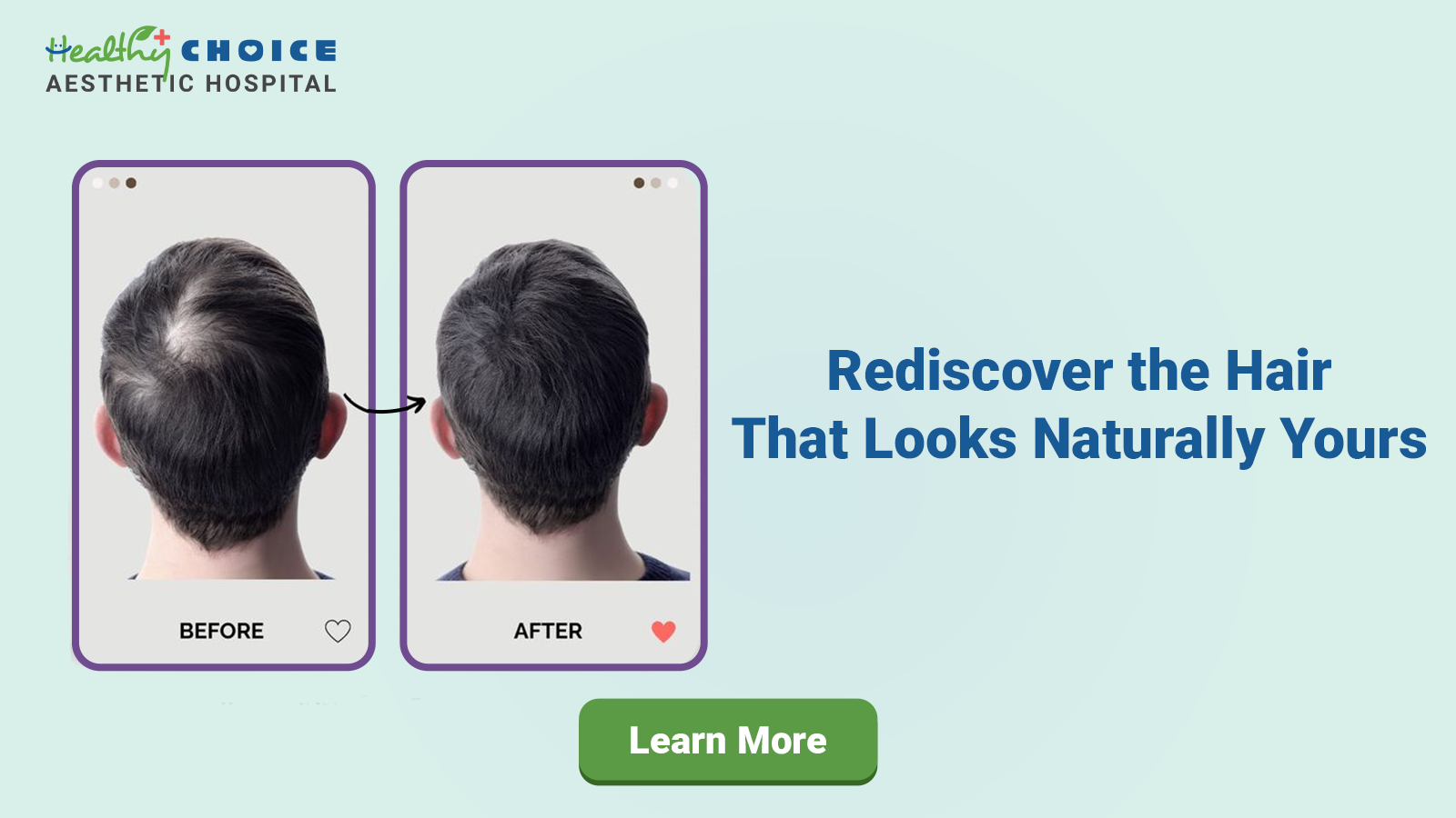 dht hair transplant